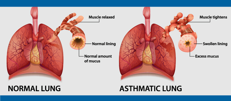 Allergy and Asthma