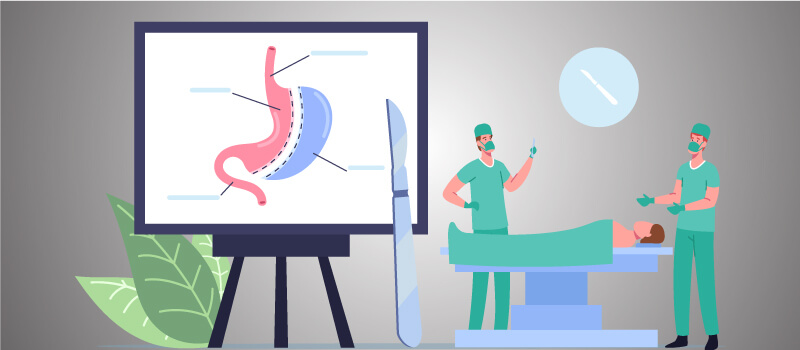 FAQs about Bariatric Surgery