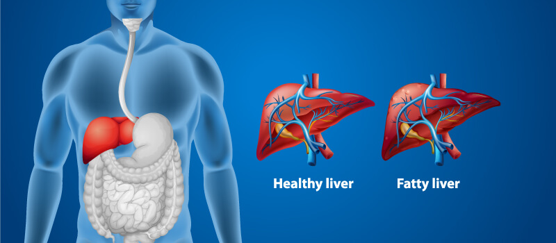 Non-alcoholic Fatty Liver Disease